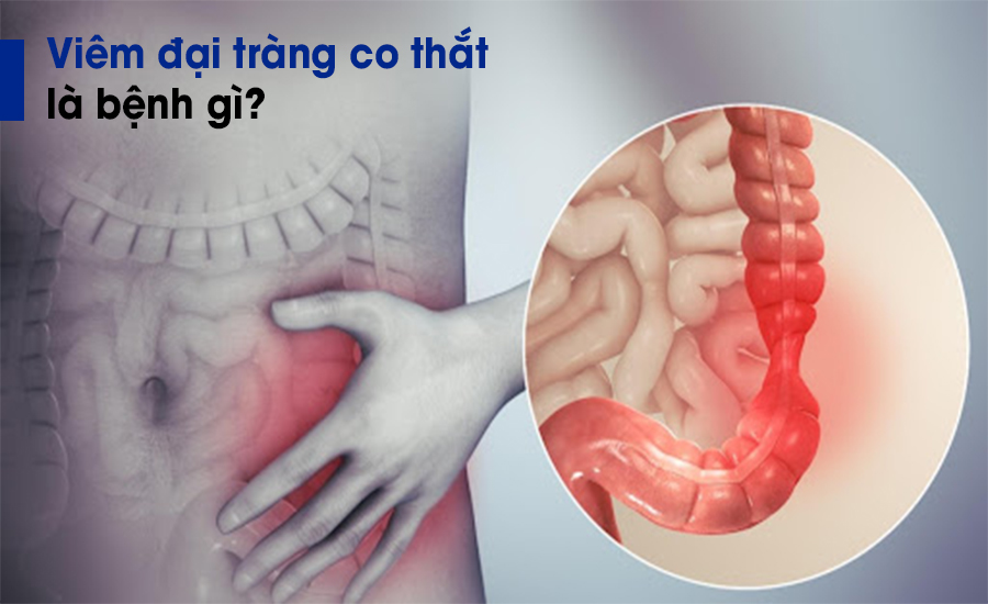 Bệnh viêm đại tràng co thắt gây ra các cơn đau co thắt vùng bụng.jpg